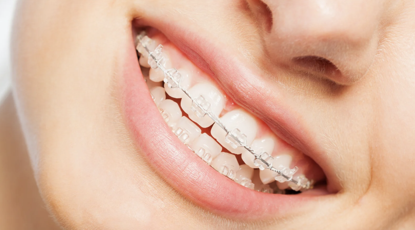 Clear adult braces